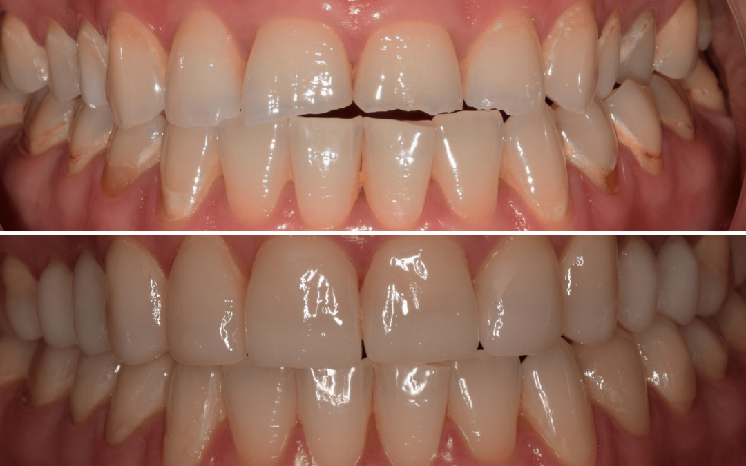 Előtte-utána: Mosolytervezés és Porcelán héj
