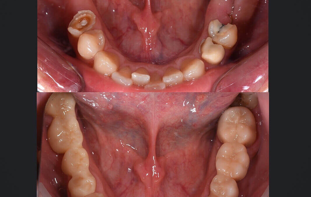 Előtte-utána: Hiányzó fogak pótlása