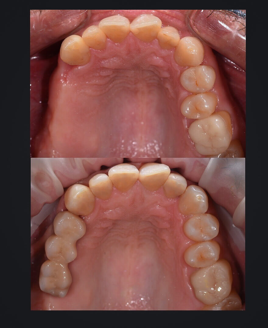 Előtte-utána: Hiányzó fogak pótlása / Differental Fogorvosi Rendelő