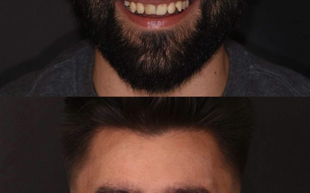 Előtte-utána: Hibátlan mosoly kerámia héjakkal