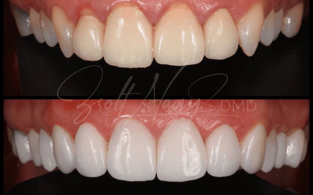 Héjkerámia előtte-utána: Ágnes átalakulása