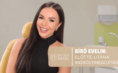 Előtte-utána: Mosolymegújítás porcelán héjakkal – Bíró Evelin